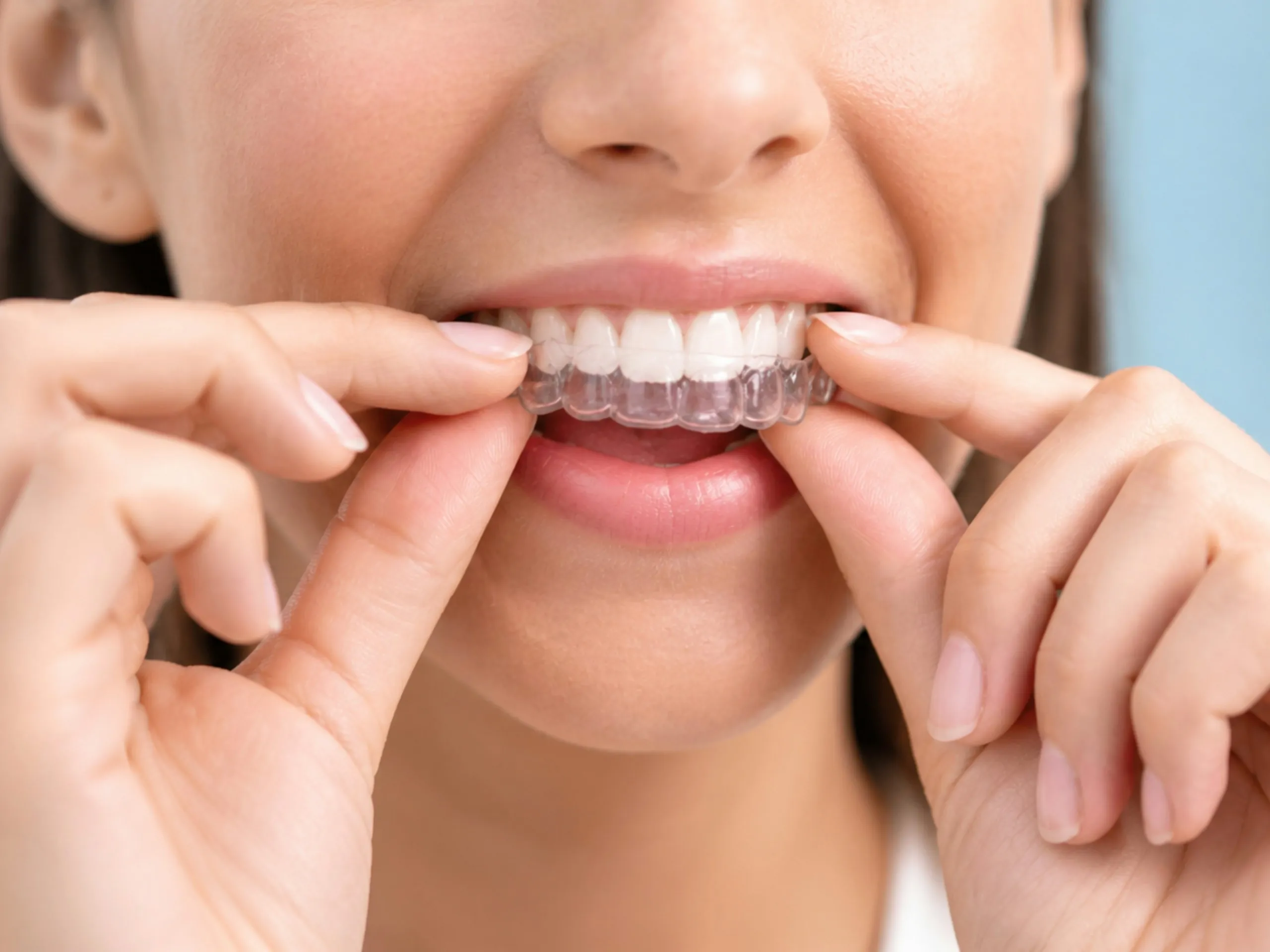 Woman fitting clear aligners