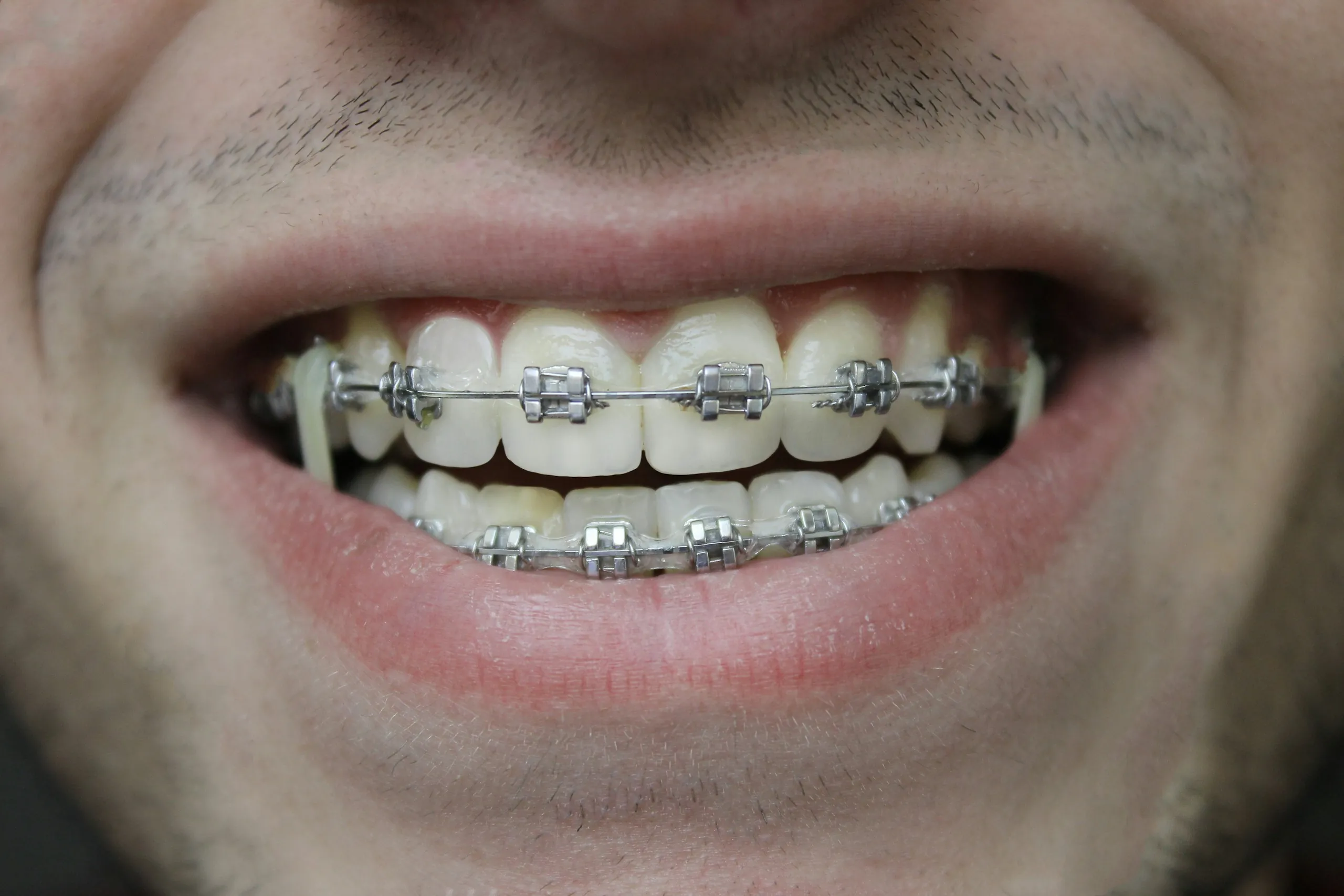 A close-up of a smile with metal braces